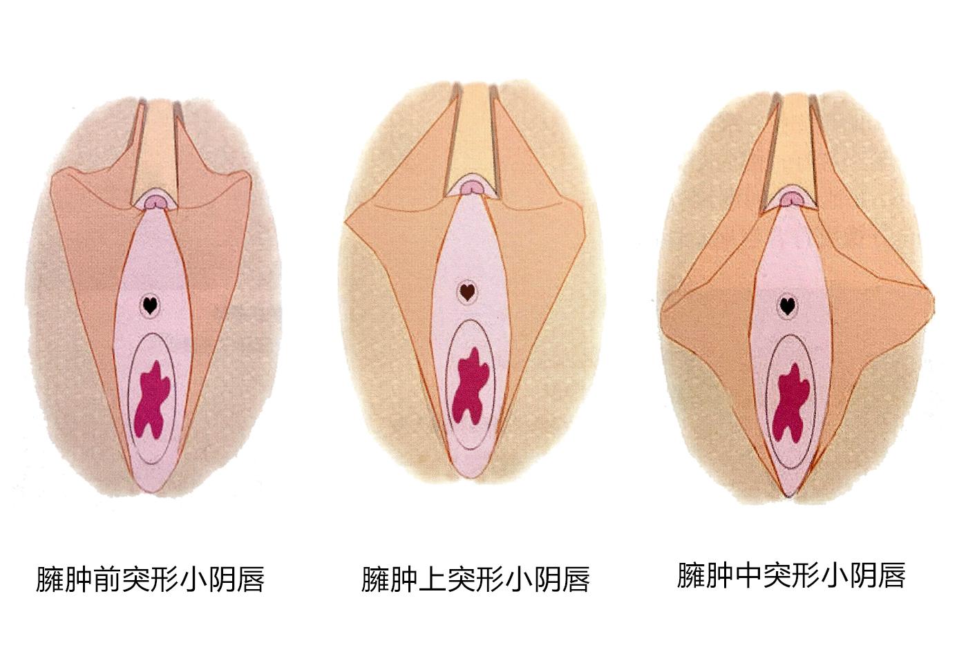 小阴唇全解 八 你的小阴唇肥大属于哪一种形态 5种形态分析 知乎