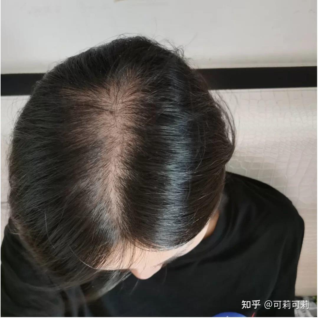 脱发发量少怎么办