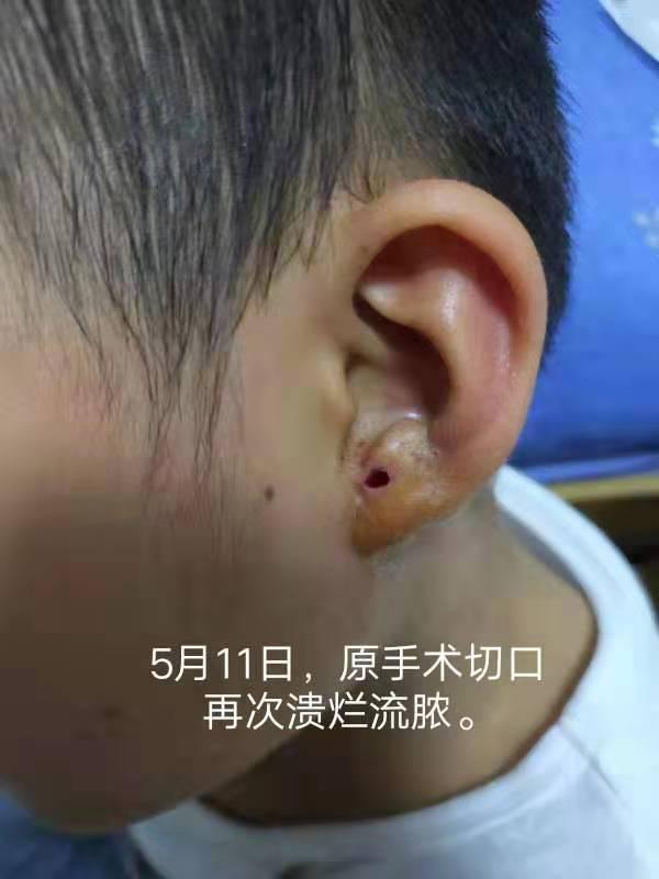 深圳8歲兒童先天性耳前瘻管手術失敗之始末手術4天后便復發甚至惡化是