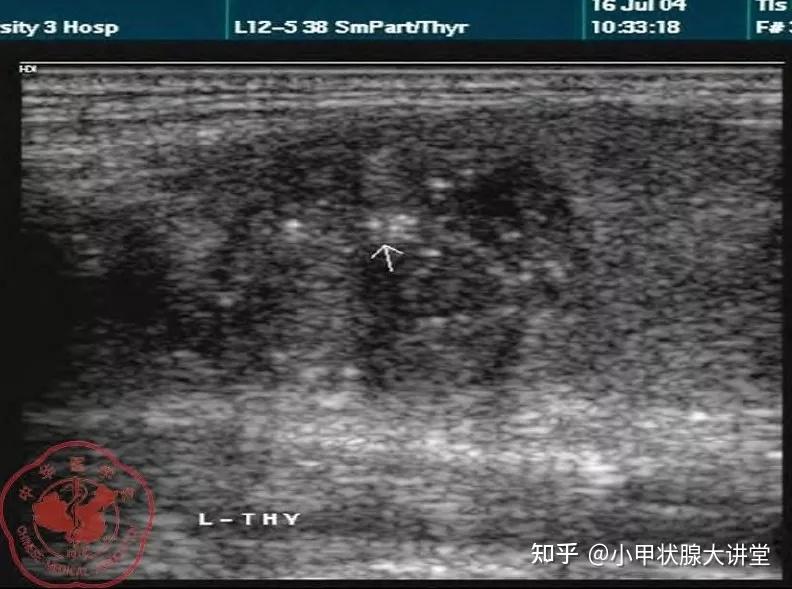 如何理解甲状腺结节钙化,血流丰富? - 知乎