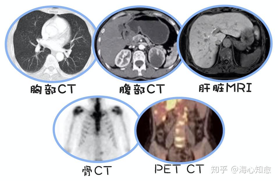 腸癌術前檢查,要做哪些才夠? - 知乎