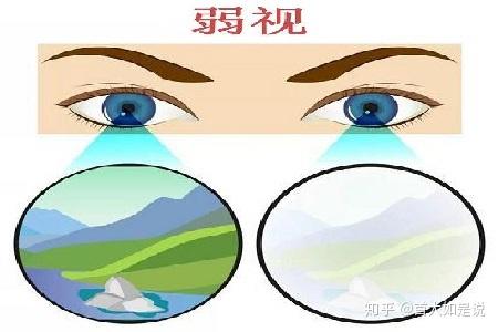 发育,那么随着年龄而增长,弱视眼的发育水平就将永远停留在早期的状态