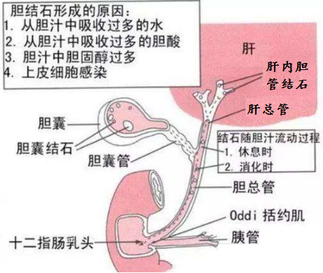 原因 胆石 症