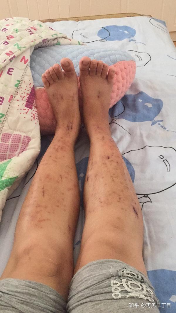 羊水过敏