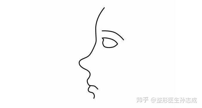 塌鼻子(低鼻与鞍鼻)怎么矫正? - 知乎