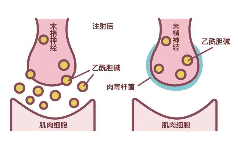 肉毒素注射深度图片