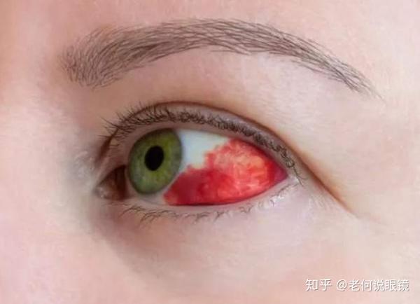 眼睛突然出血怎么回事?