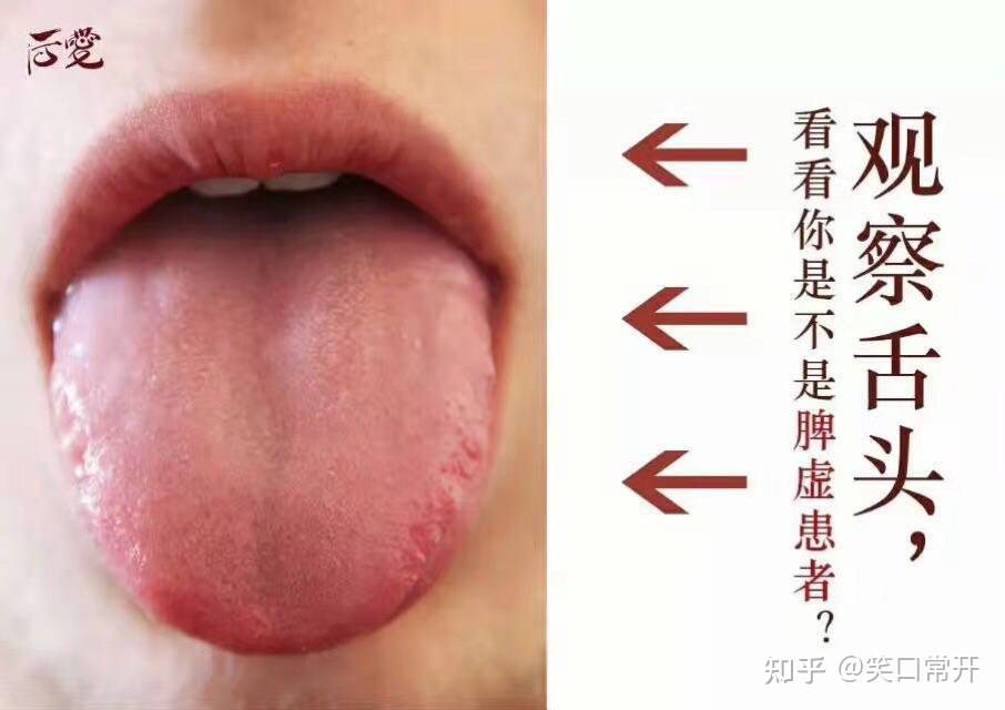 舌头中间有裂纹,跟频繁性生活有关哦!现在知道还不晚!!! - 知乎