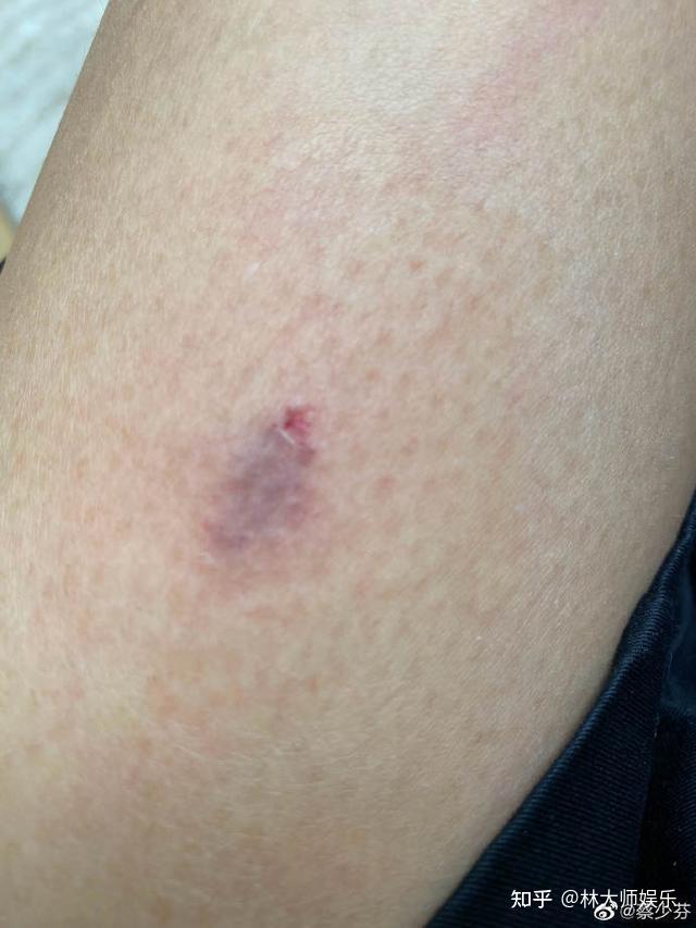 蔡少芬自曝紧急入院被狗咬伤去打疫苗满脸憔悴伤口照片曝光