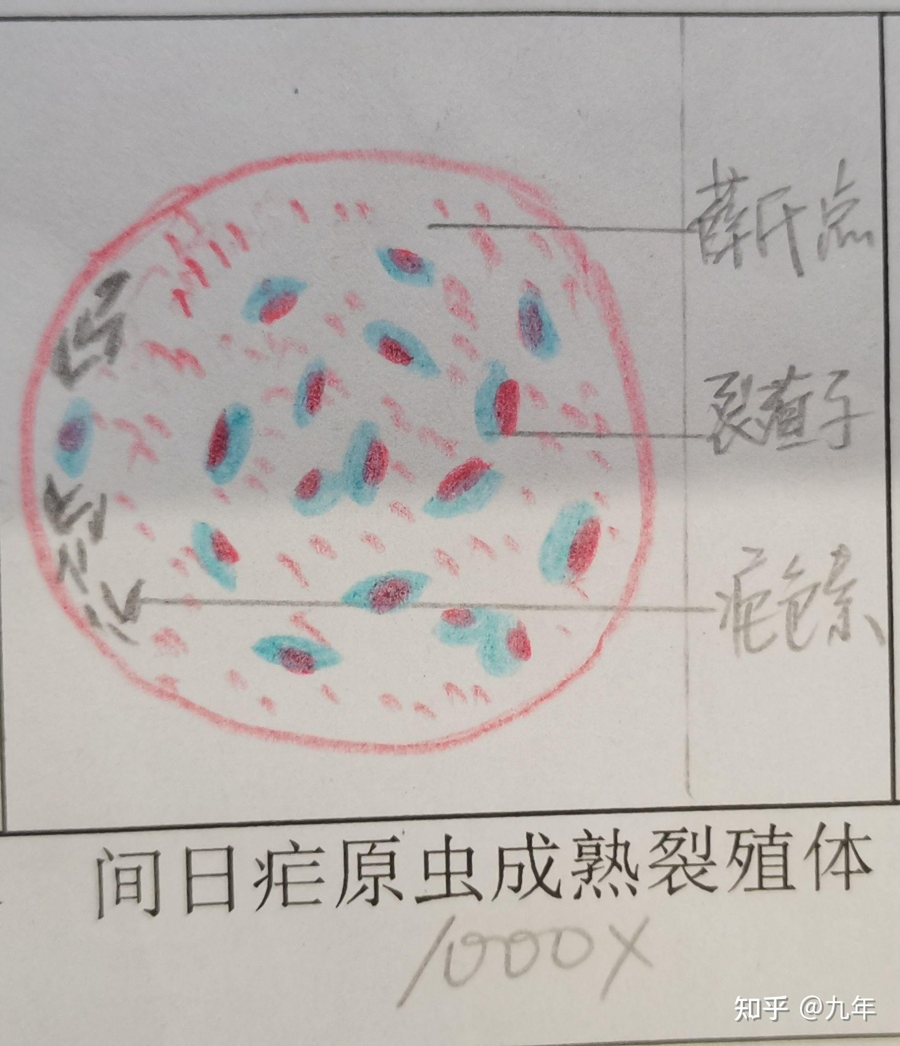 恶性疟原虫红蓝铅笔图图片