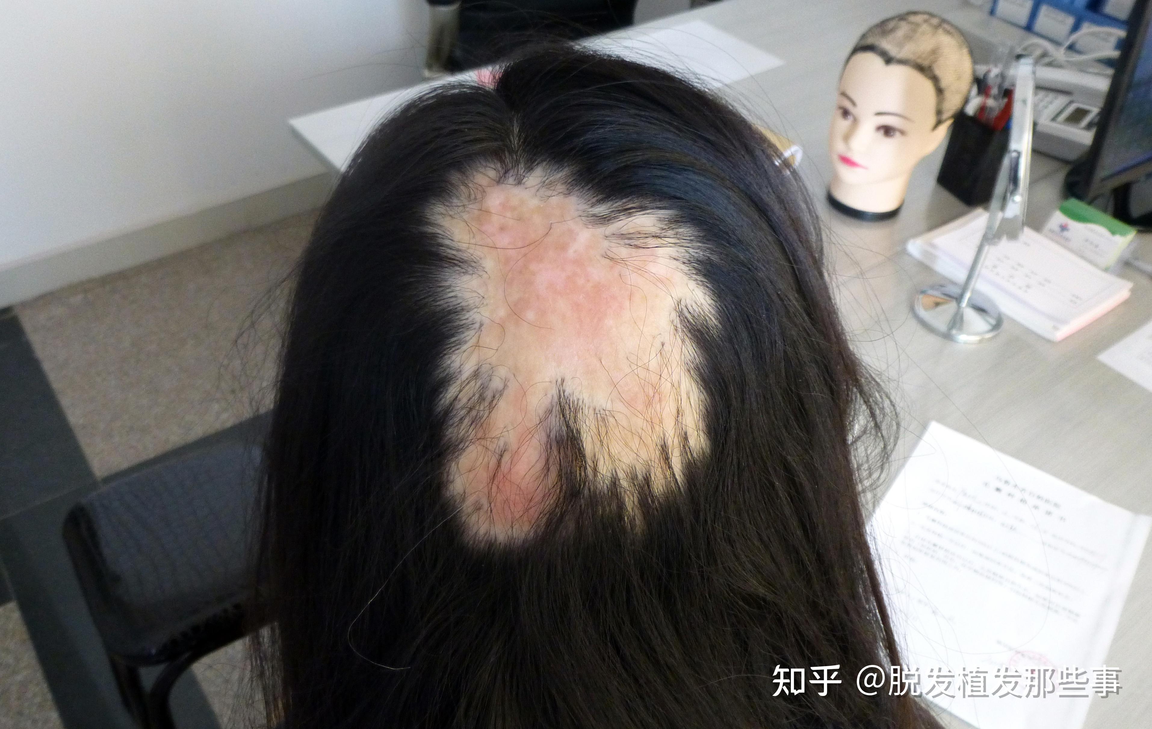 头部14厘米疤痕时隔12年也能修复？ 12岁男童开颅术后“除疤记” - 知乎