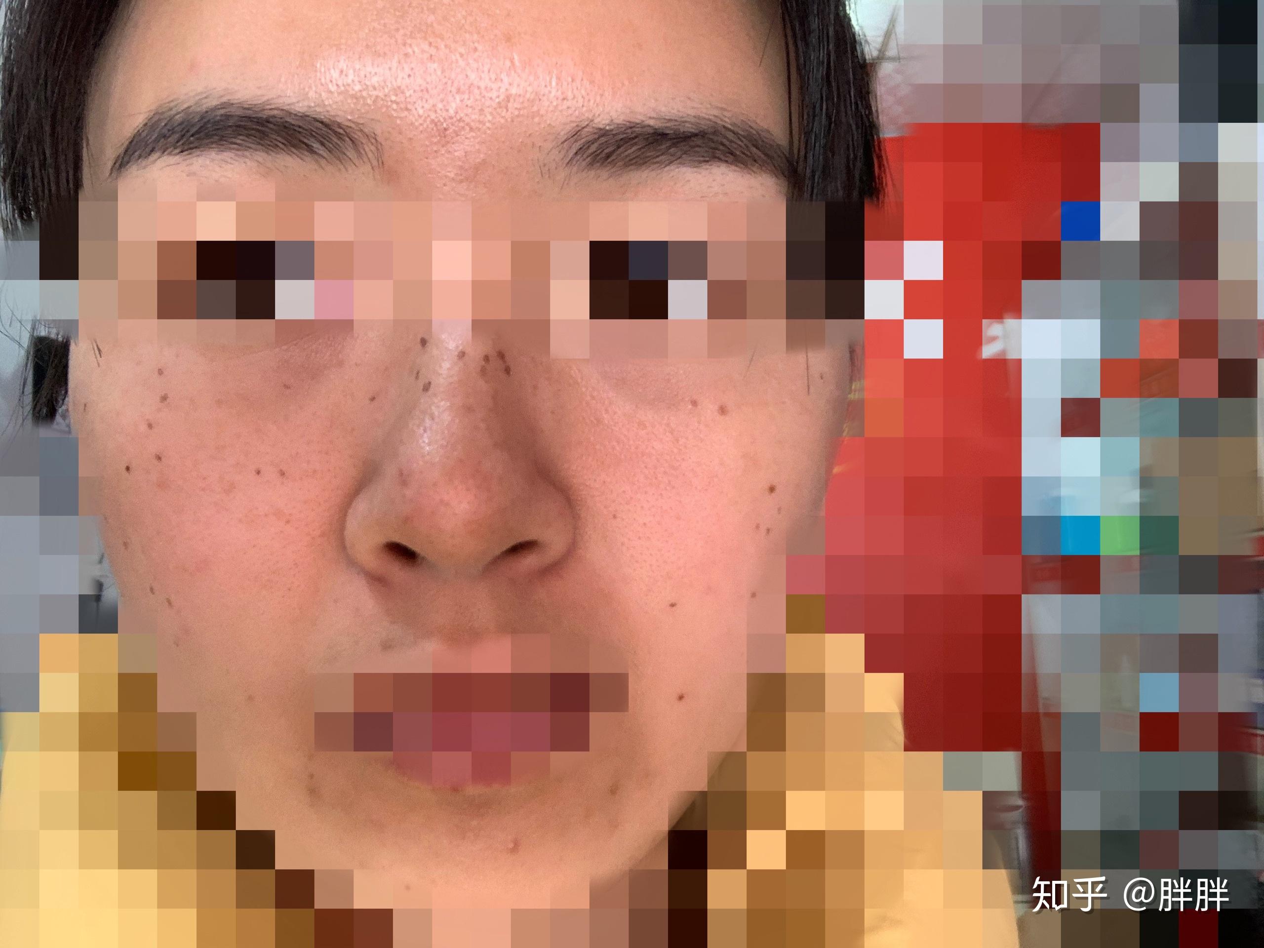 日记：我在日本的皮肤诊所做了调Q红宝石激光祛真皮斑（ADM）（持续更新中） - 知乎