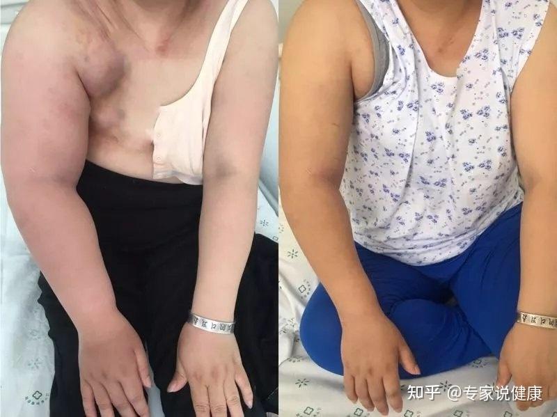 乳腺癌患者术后3年