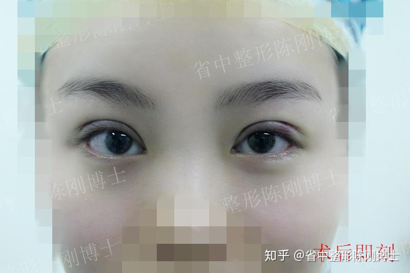 全切、微创,做好双眼皮很实际