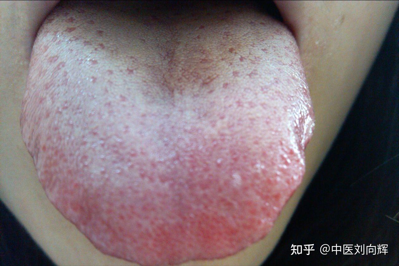 伸出舌头一看,舌头比较胖大,舌苔白腻,那多半就是体内湿气比较重了