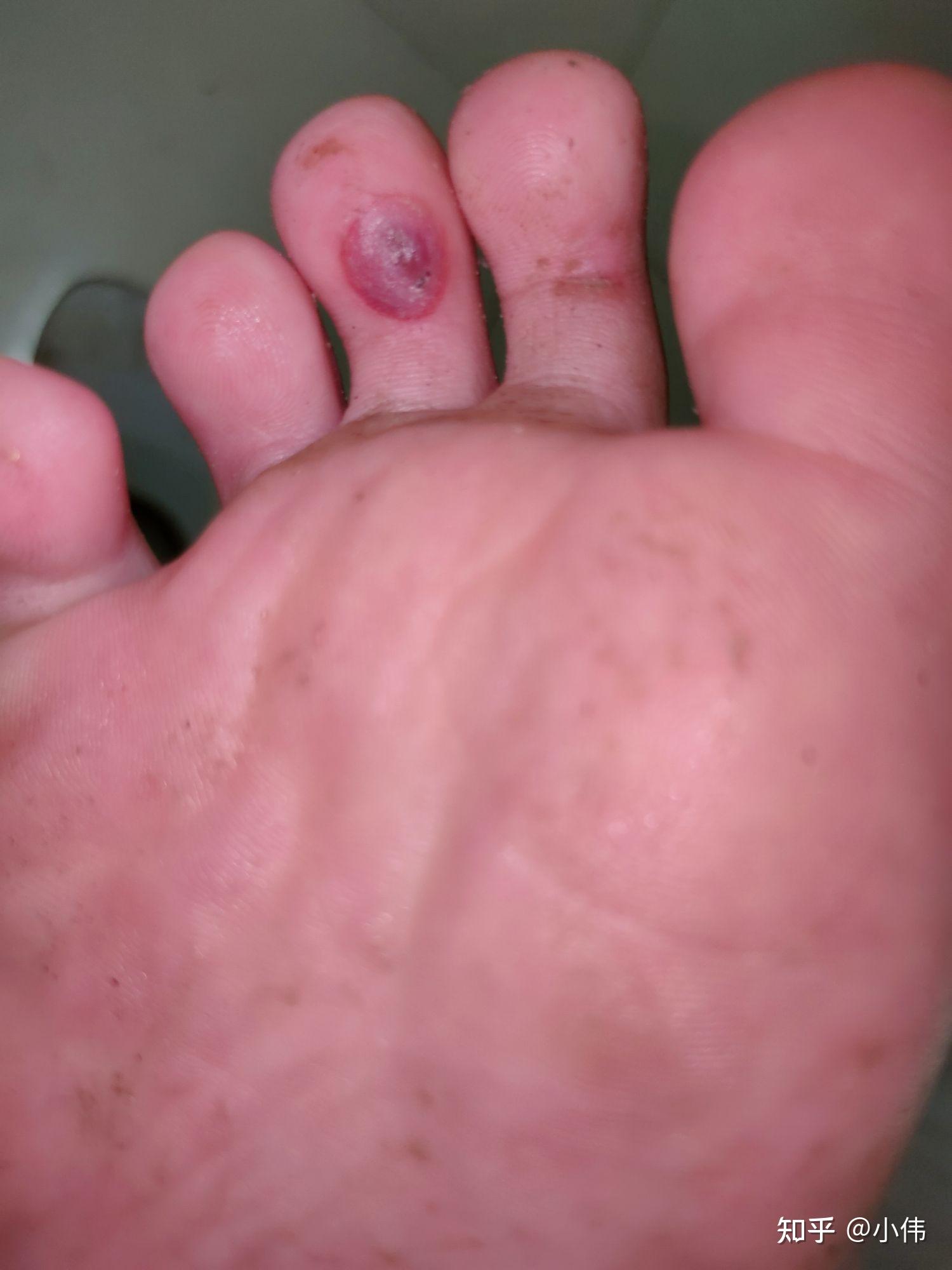 脚趾冻疮症状图片图片