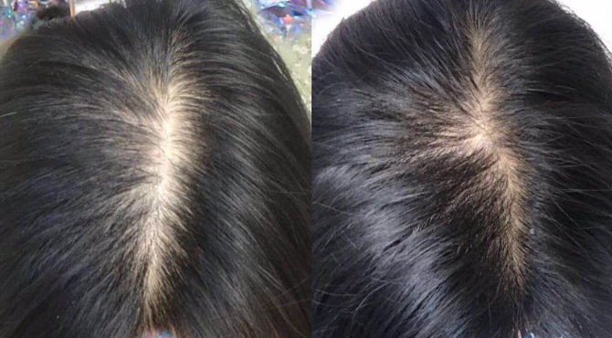 本人是名女性,患有脂溢性脱发加上轻度毛囊炎,小的时候发量很多,哟种