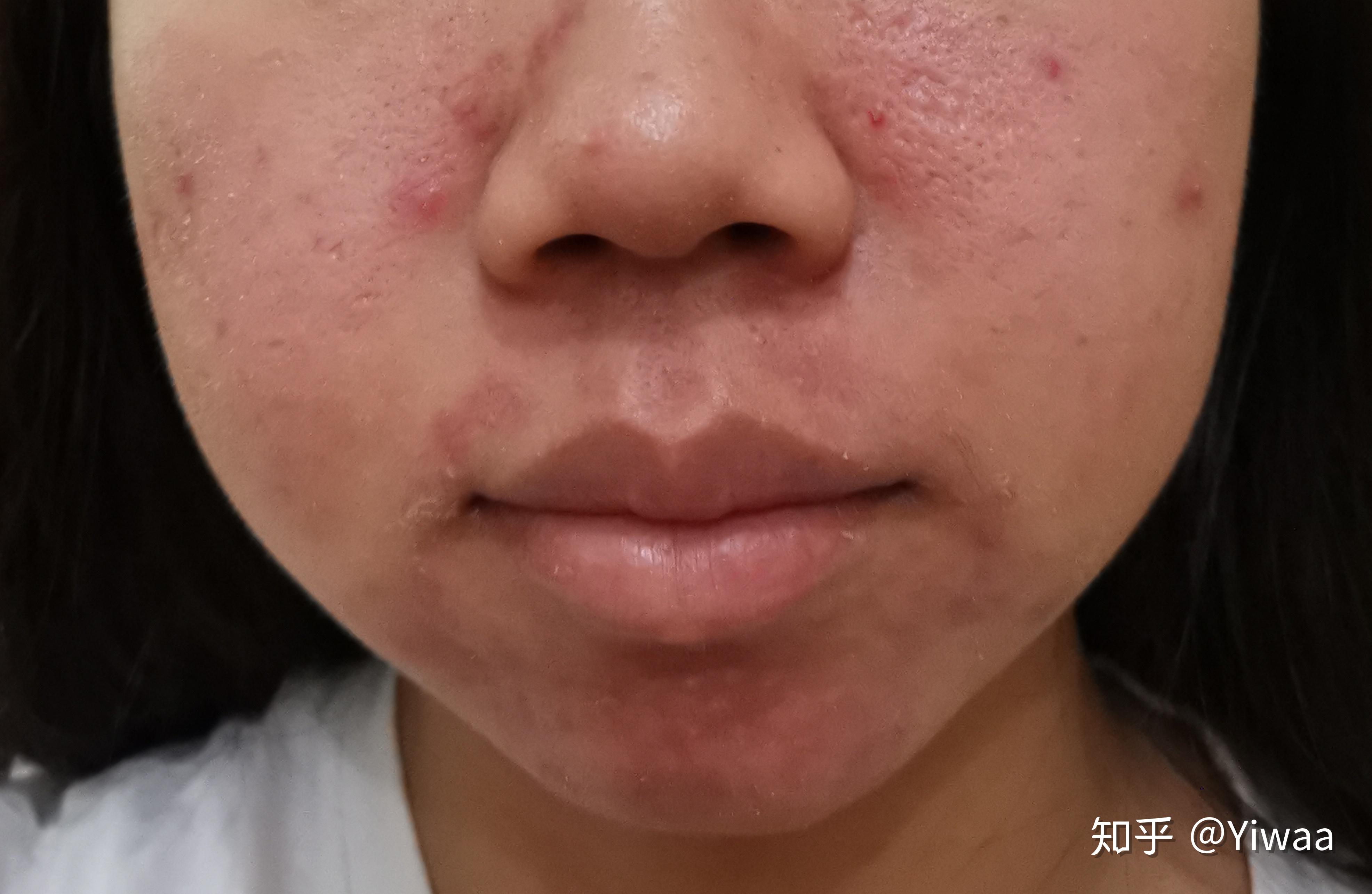 记录服用泰尔丝异维a酸软胶囊