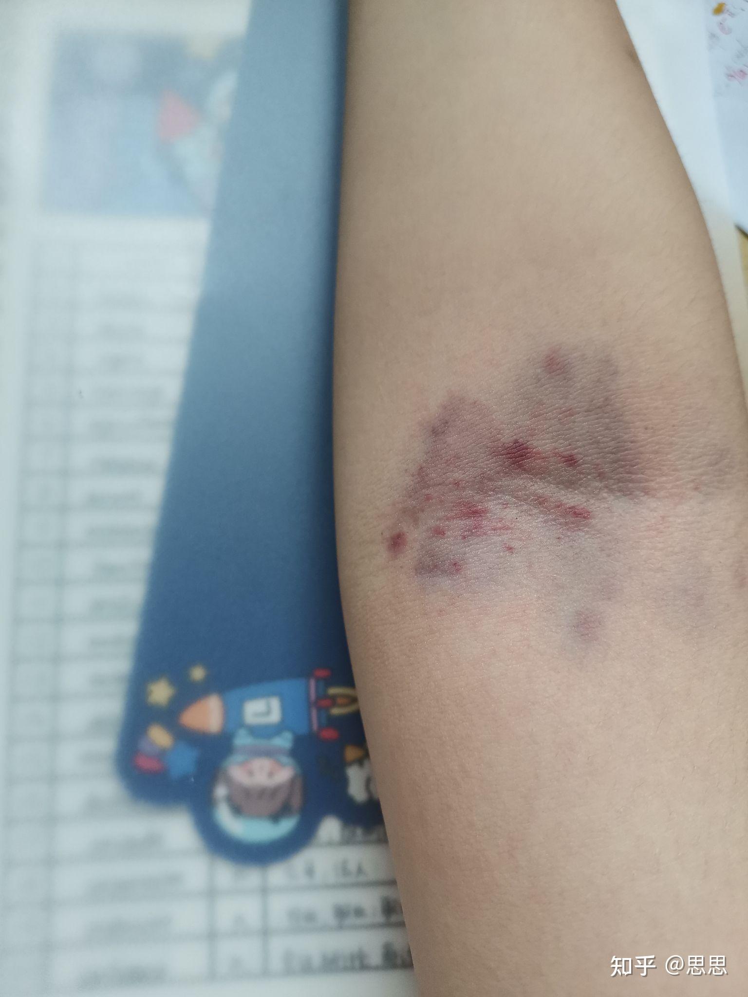 拍胳膊窝可以排毒去湿气