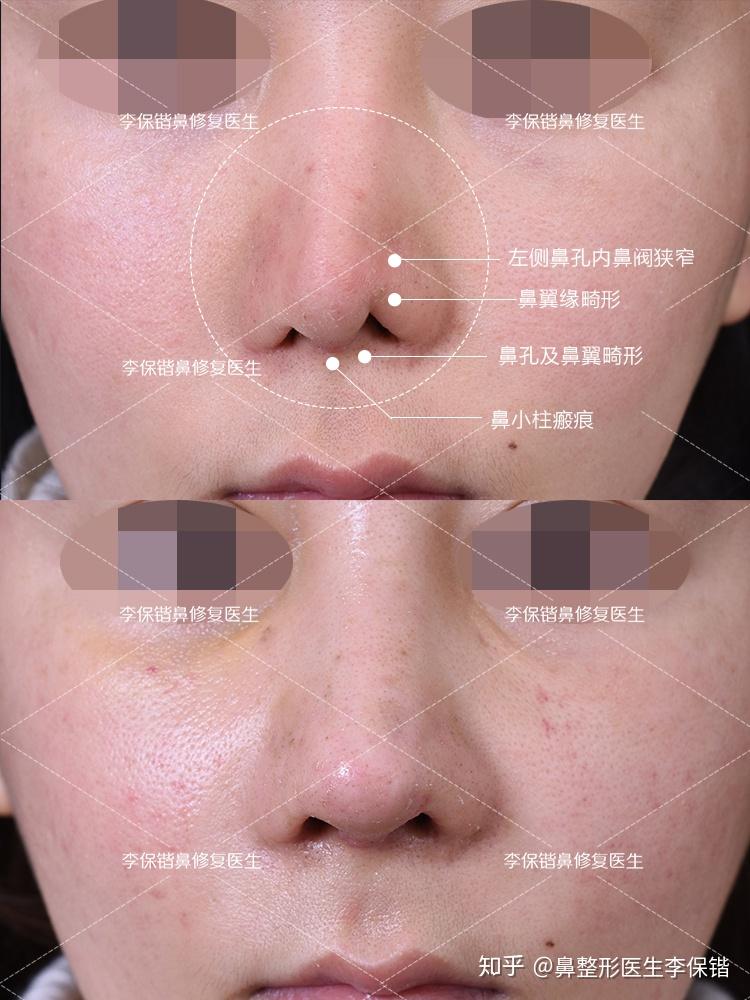 为什么鼻修复越来越难做呢