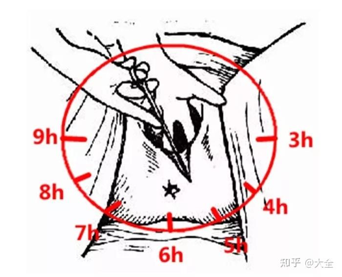 顺产侧切和剖腹产都是挨一刀哪个伤害小