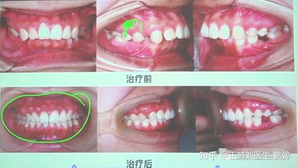 难度超5星!单侧正锁颌,严重偏颌患者,如何不拔牙,配合支抗钉完美解决! - 知乎