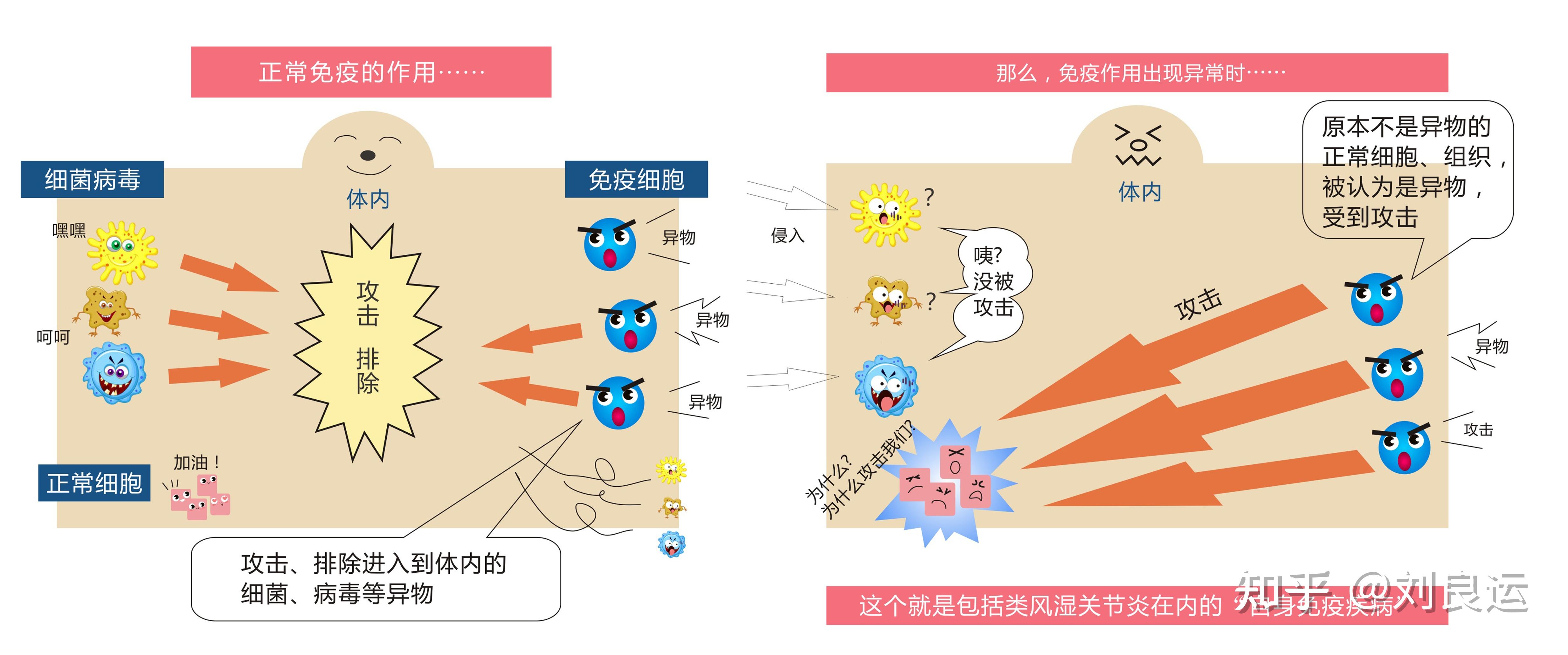 患者的免疫系统不明原因发生了紊乱,免疫细胞将自身滑膜细胞当成