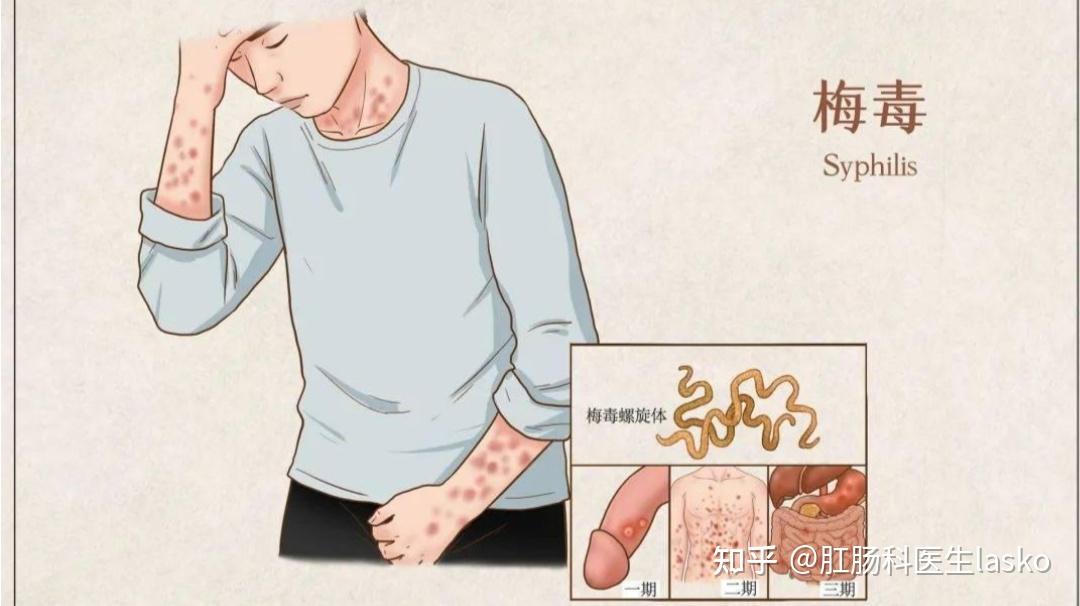 认识一下梅毒,一二三期梅毒都有什么特点,怎么治疗 - 知乎