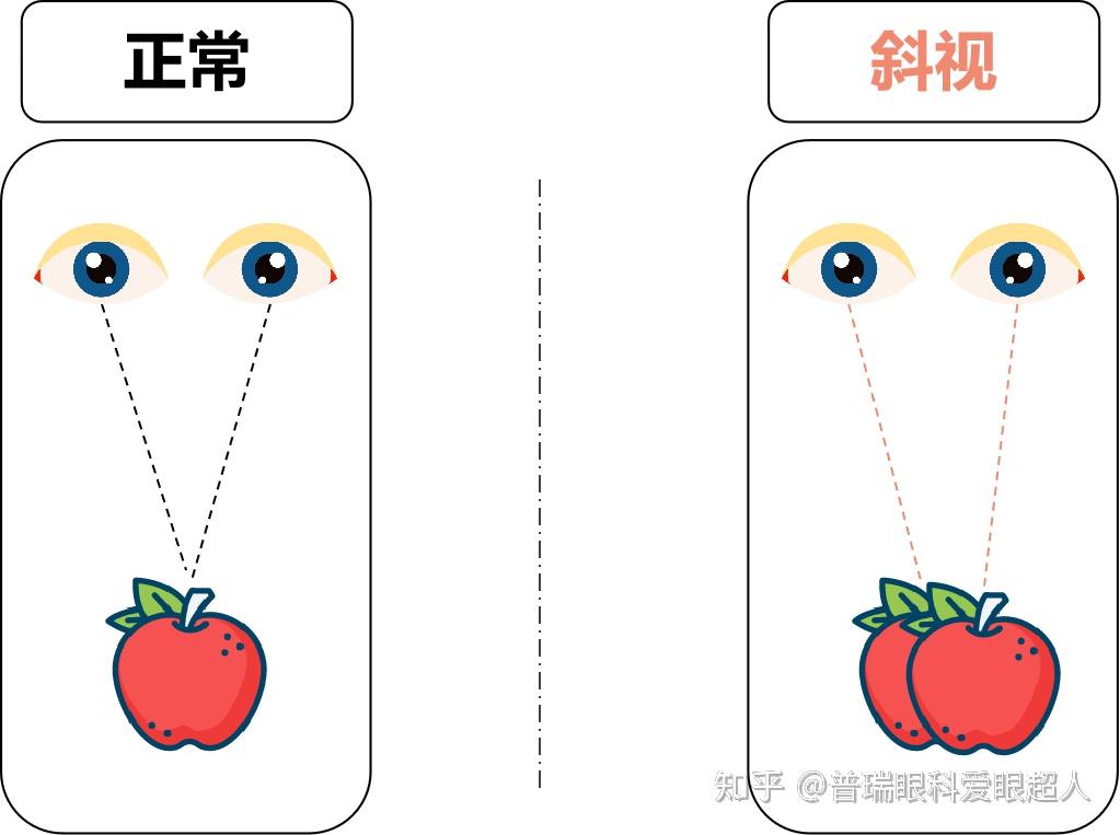 斜视是种什么体验!还有救吗 - 知乎