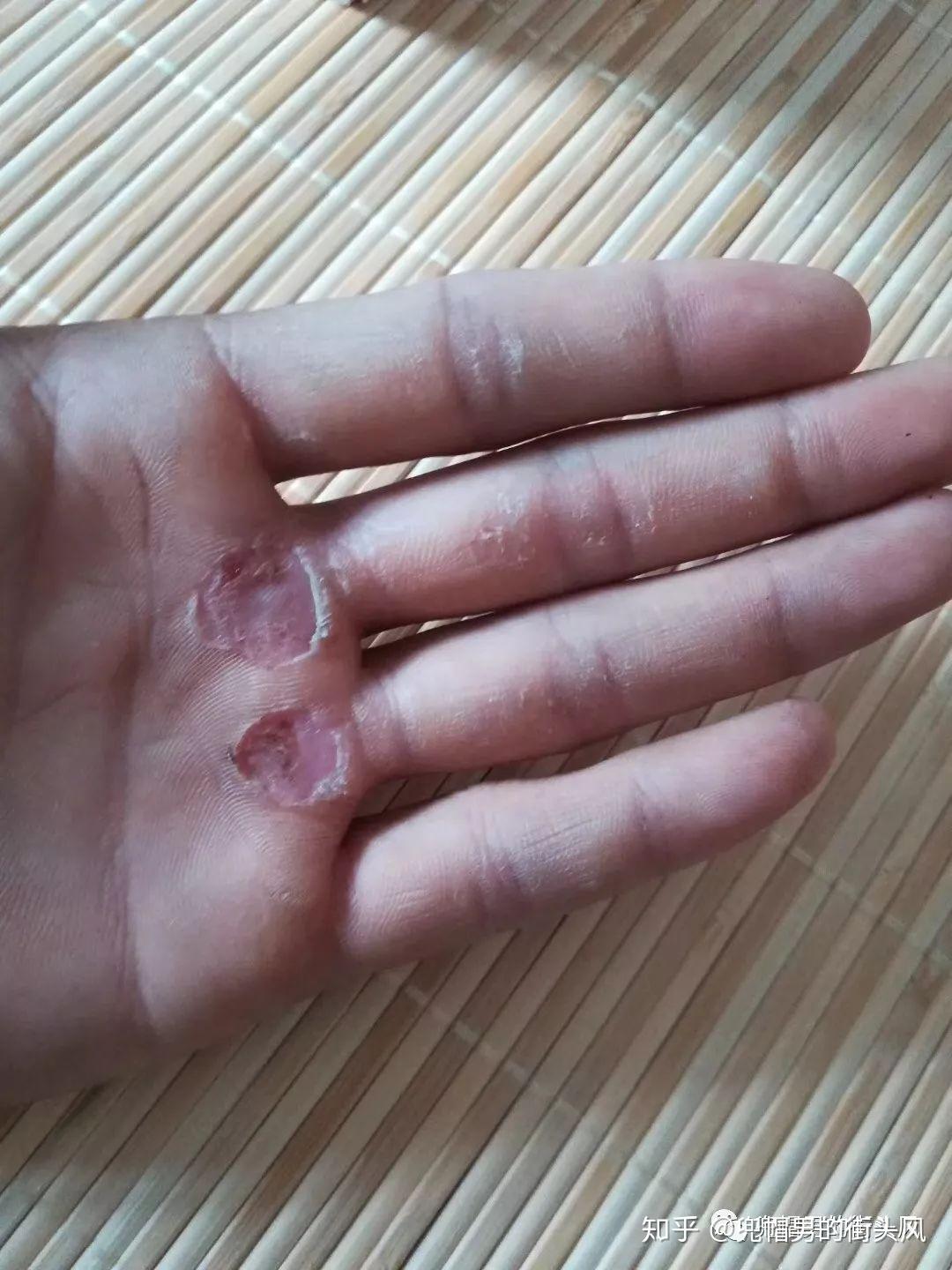 每一次受伤我都会把它当做一种荣耀,它会成为刻在身体上的烙印