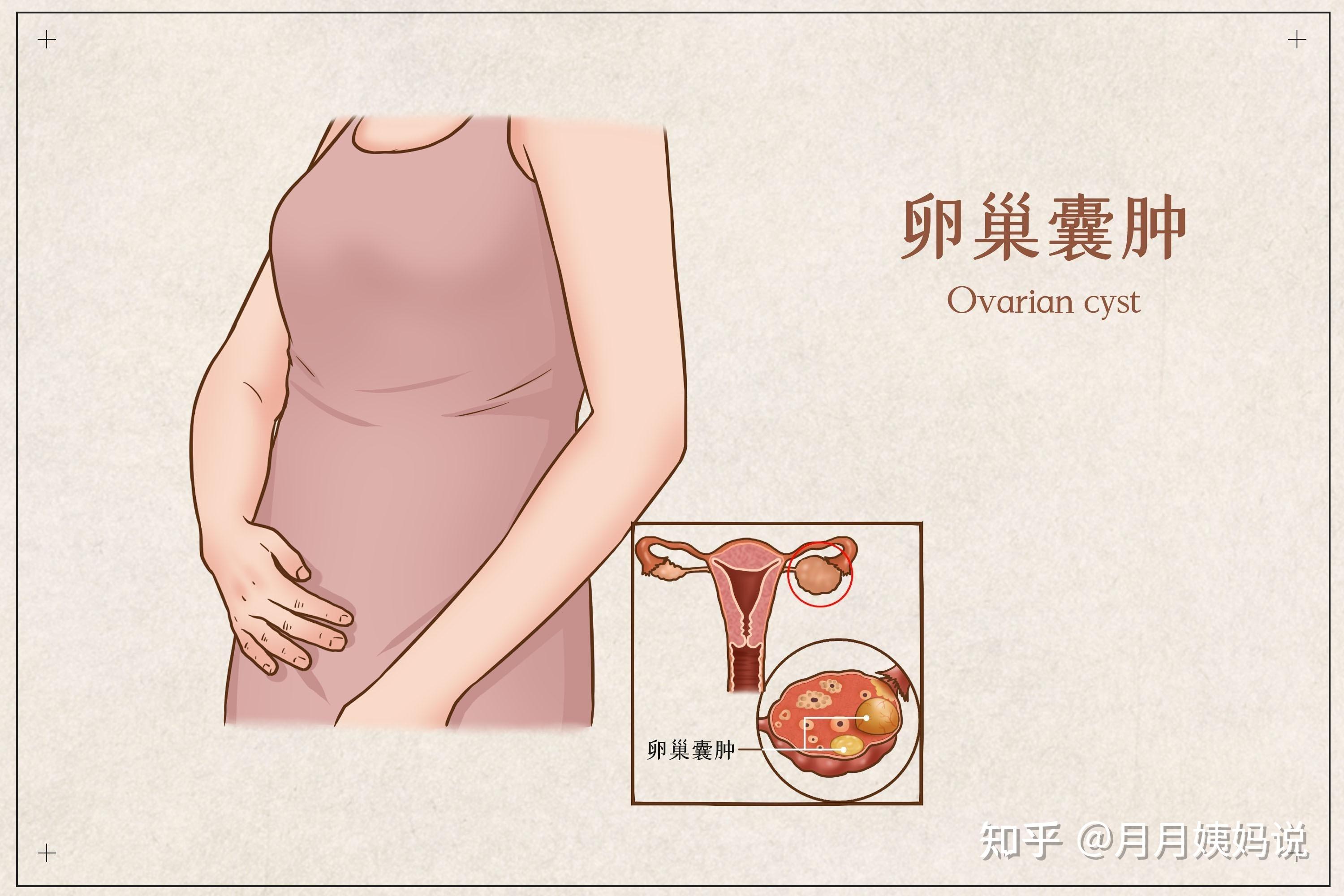 卵巢囊肿怎么办？