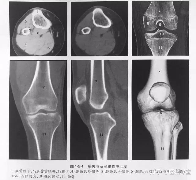 脊柱骨关节常见变异常见的骨关节变异有骨岛(又称内生骨瘤who 2013)