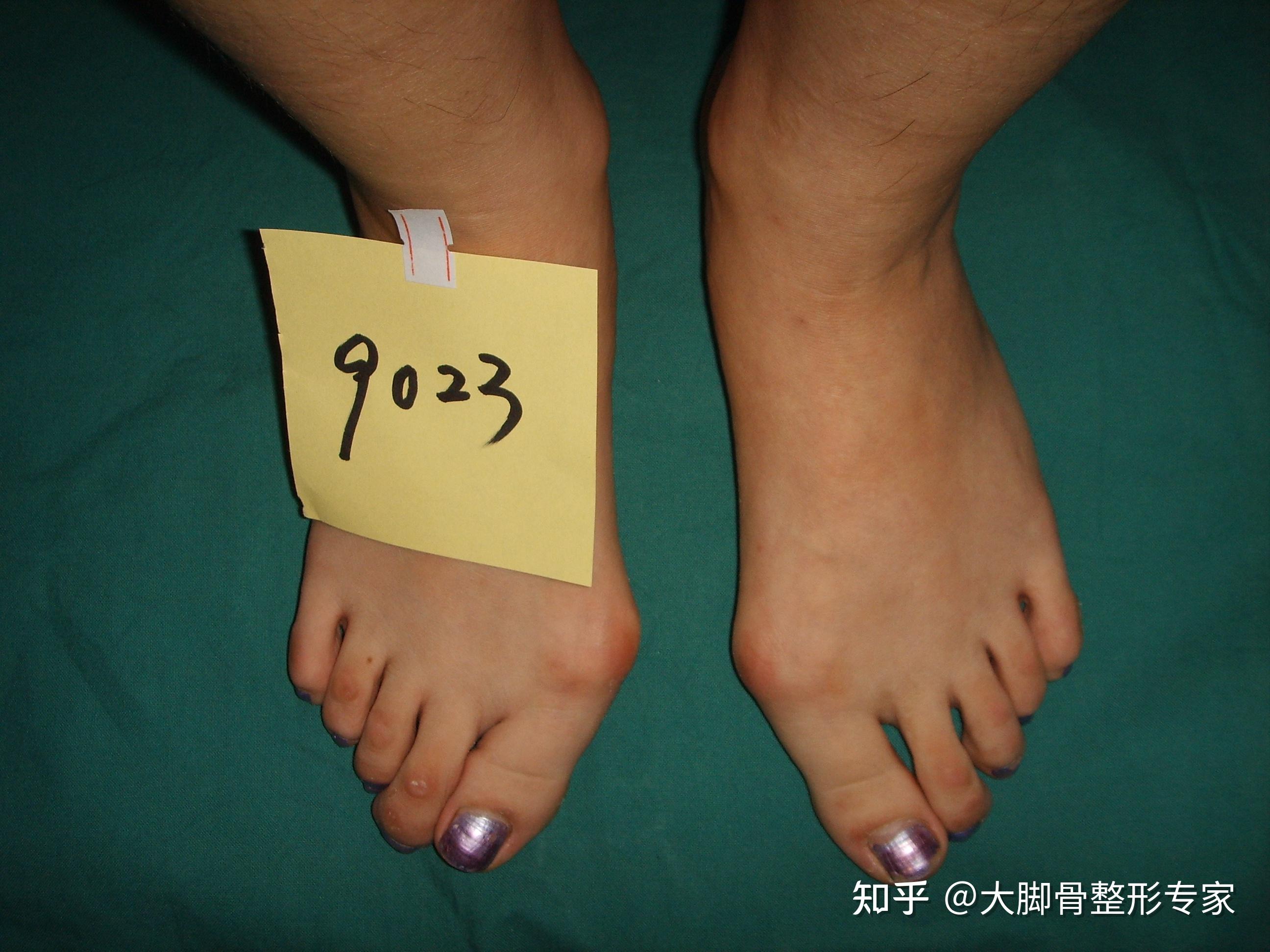 哪些大脚骨会快速发展拇外翻