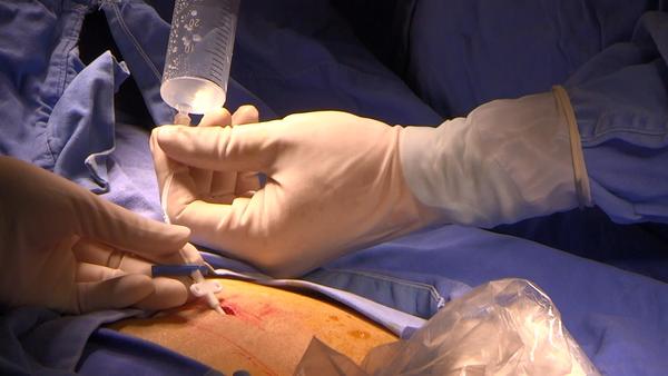 超声下经皮穿刺腹透导管植入附视频