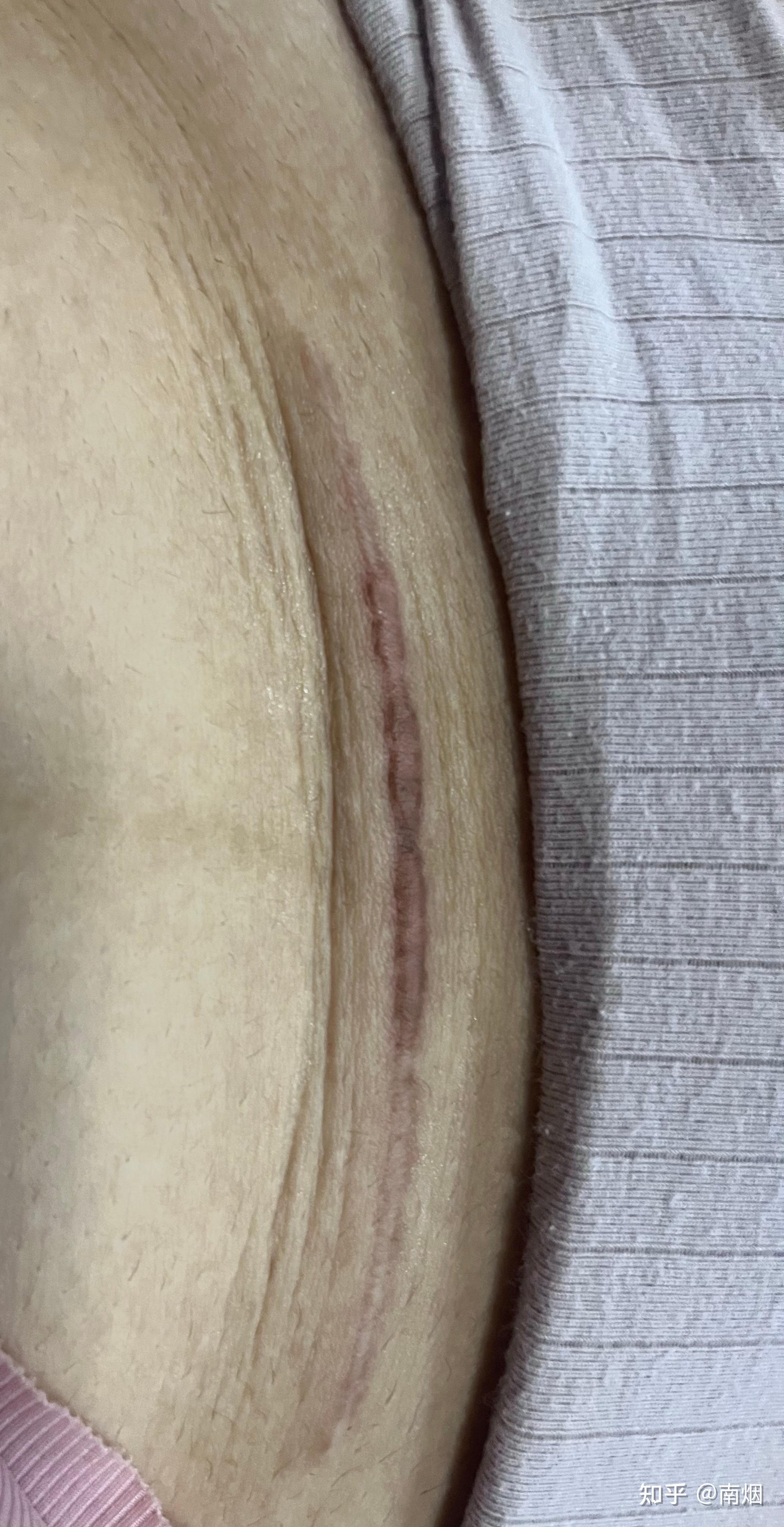 关于剖腹产疤痕增生
