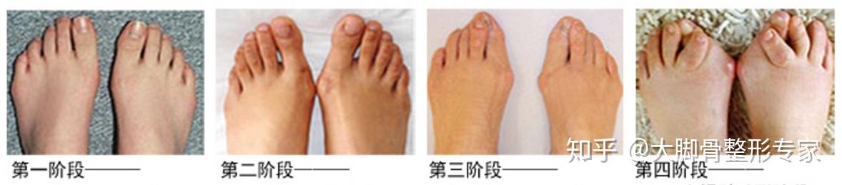 拇外翻需要治吗？需要怎样治疗？ - 知乎