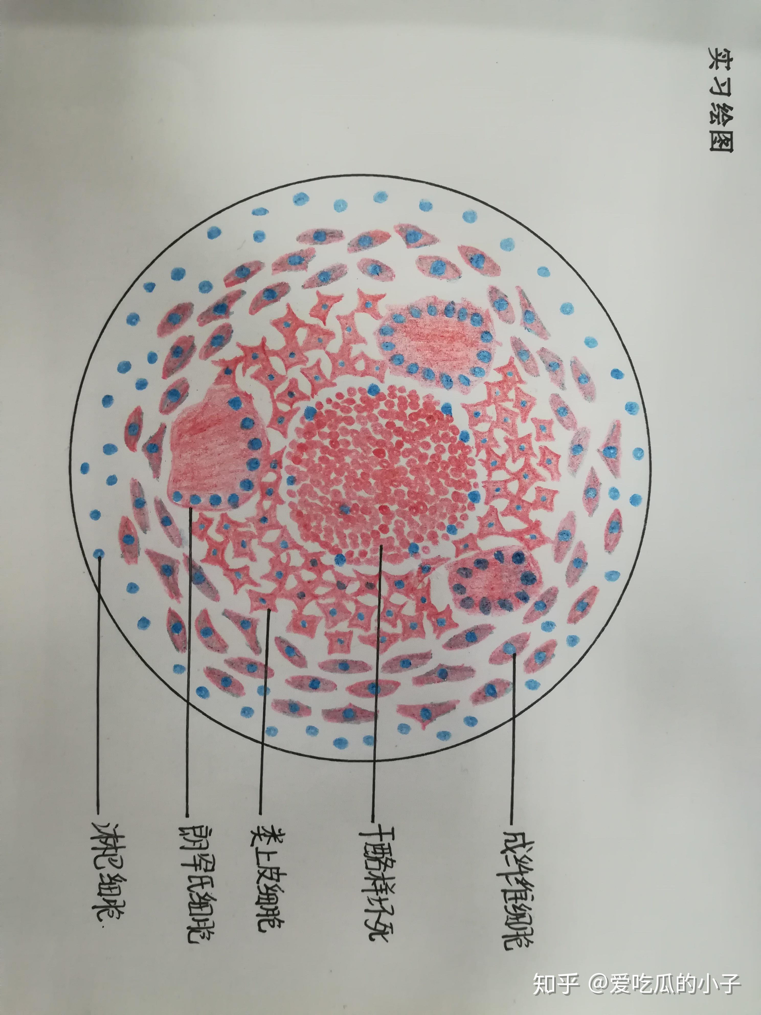 结肠腺癌细胞手绘图图片