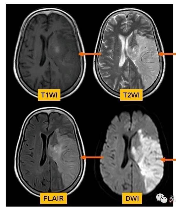 神内临床笔记58 脑梗死 mri病例汇总