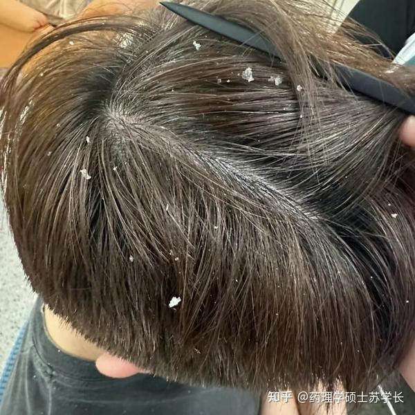 男生头屑多到像下雪,二硫化硒用了、土方子也用了,没效果!有什么牛逼的方法能快速去头屑的吗?【医学硕士】教你3步,解决男生头皮屑问题,一个月还原 ...