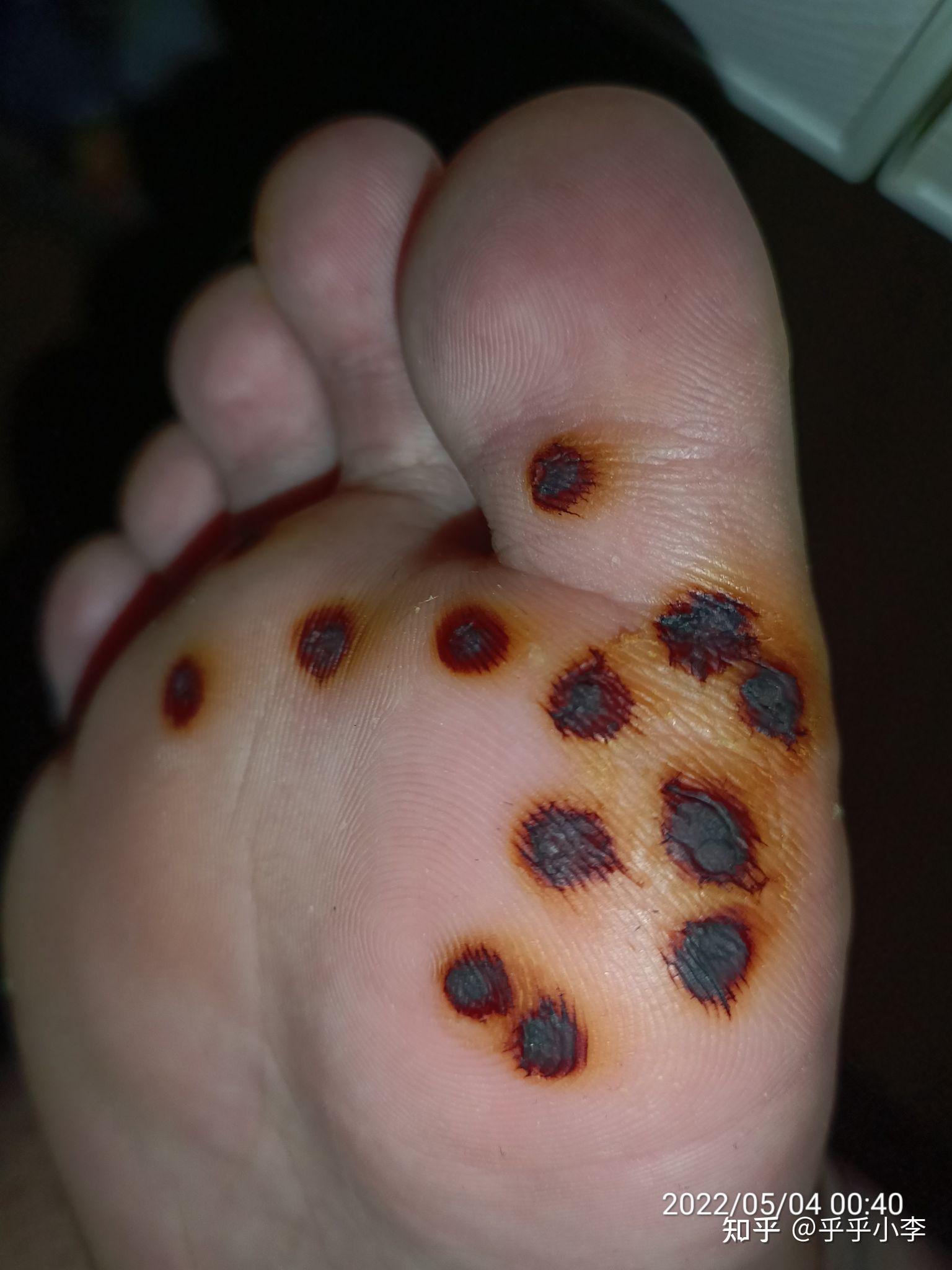 10浓碘酊治疗跖疣