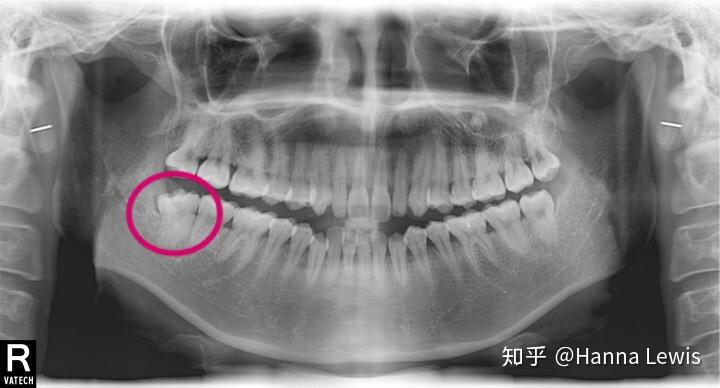 拔牙齒拔智齒