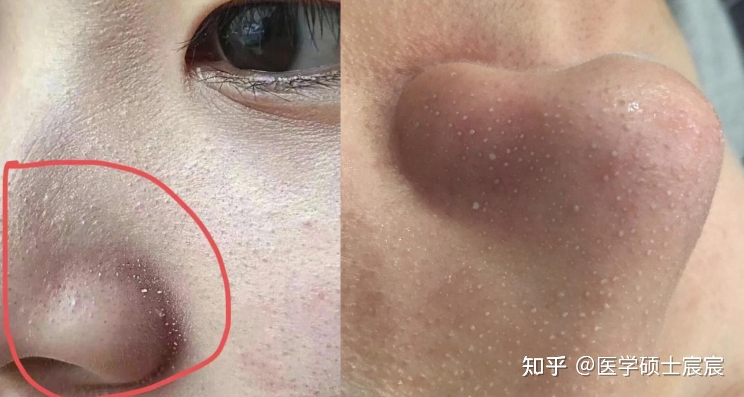 脸上白头粉刺冒个不停,挤出来一条一条的,真的没救了吗?皮肤科医生总结1000+典型案例:4步解决万年白头粉刺!【28天】高效解决,皮肤光滑平整!