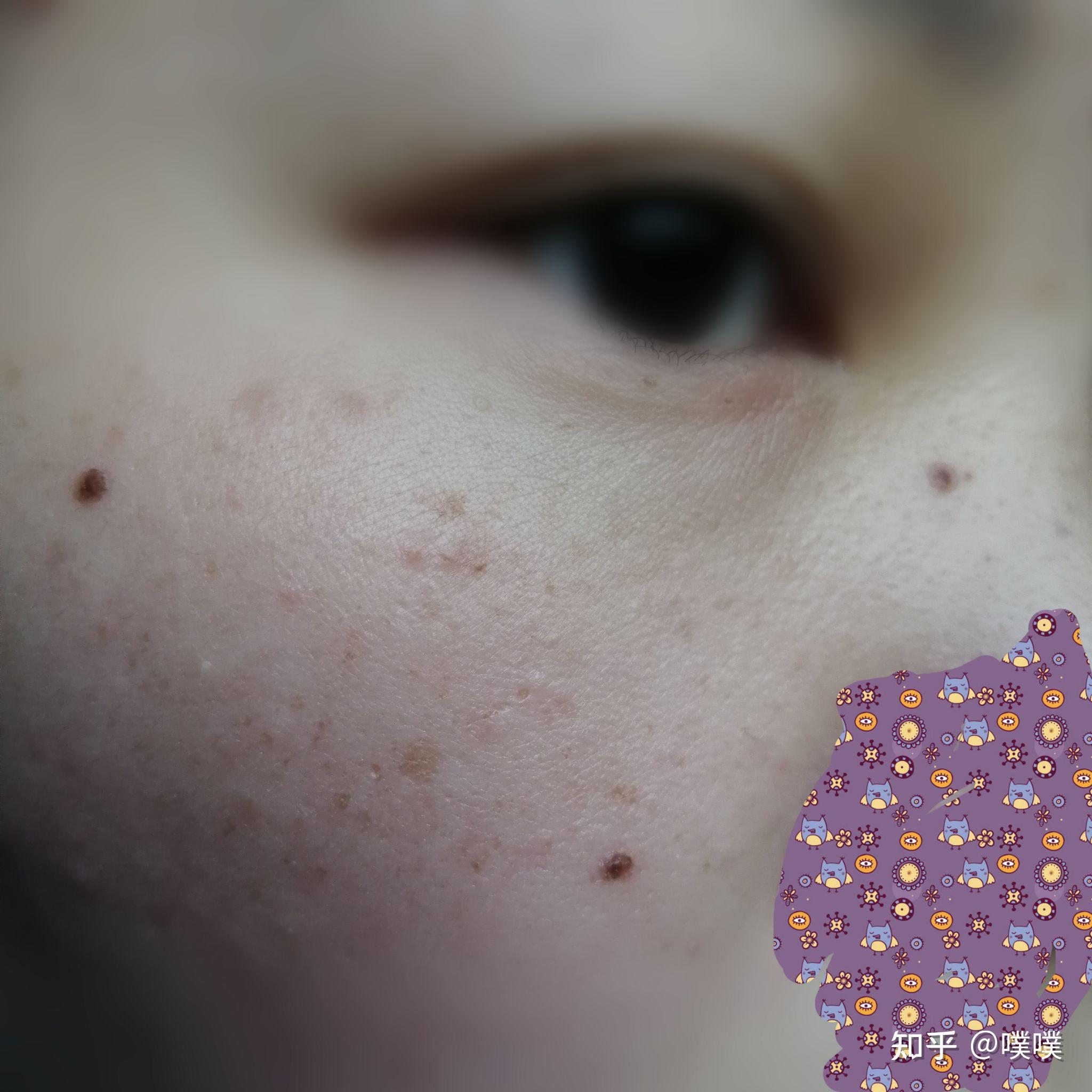 液氮冷冻点痣记录贴