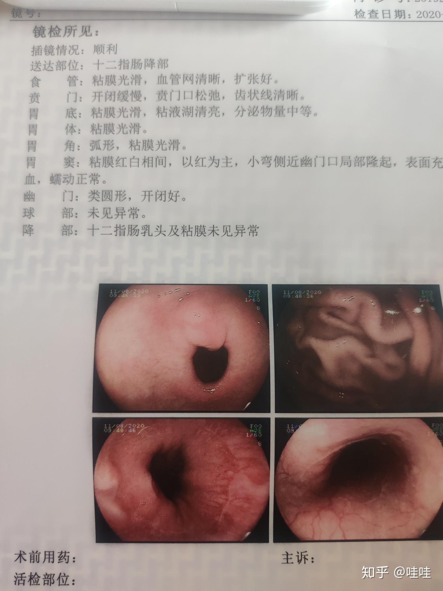 贲门癌的胃镜检查表现图片