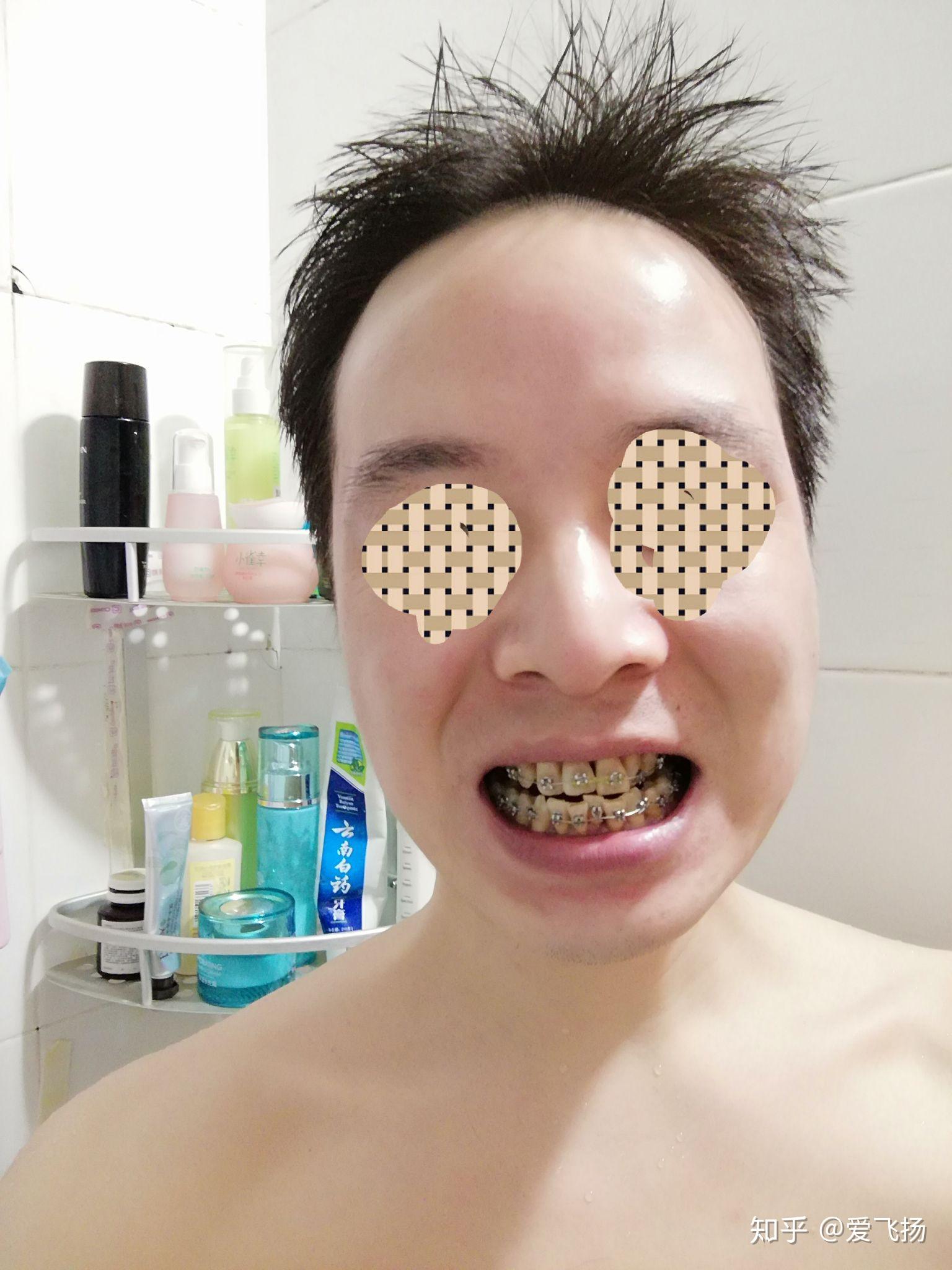 35岁大叔开始带牙套嗯