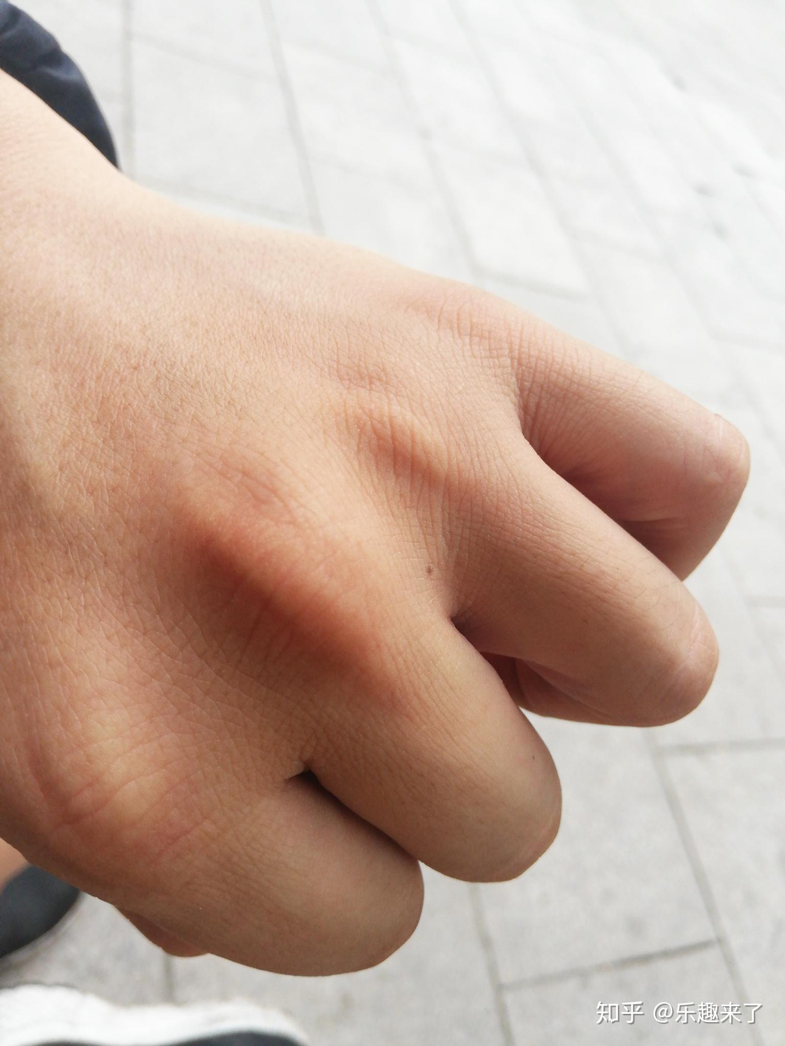 本人女左手无名指半年前多新长了一颗痣 有什么寓意? - 知乎