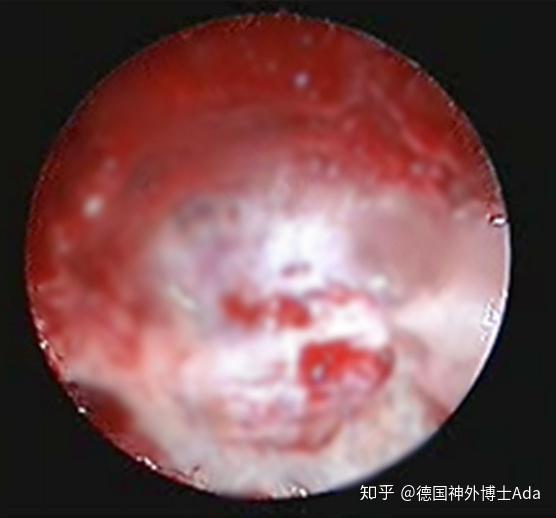 胼胝体怎么形成的 v2-d05cb92fe4309b2417d300e57bad5ca3_r.jpg