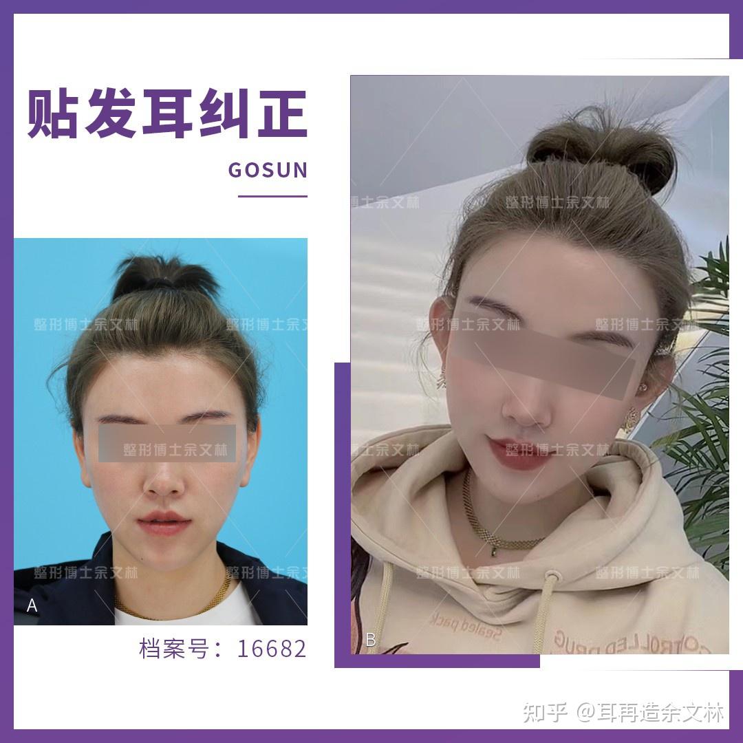 【贴发耳】看了这么多艺人证件照,好像没有耳朵贴面的明星? - 知乎