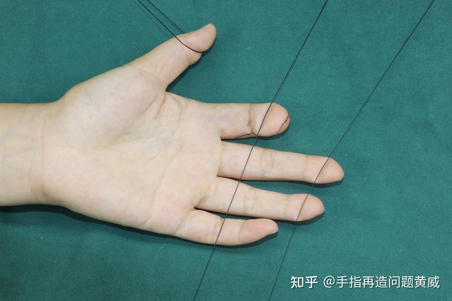 再造的是真手指吗?手术过程是全麻吗?所有手指都可以再造吗? - 知乎