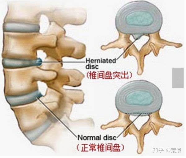 腰椎间盘突出自我疗法百 腰椎间盘突出最佳的运动 知乎